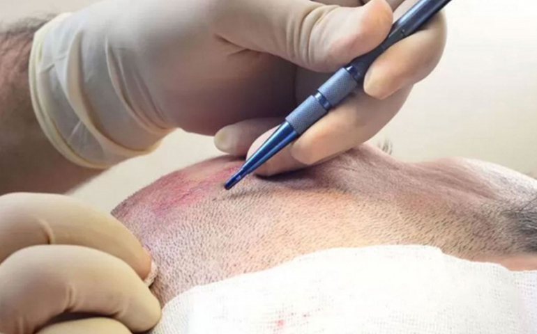 safir-fue-sac-ekimi Safir Fue Saç Ekimi